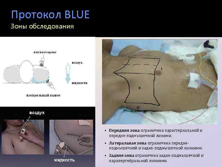Протокол BLUE Зоны обследования • Передняя зона ограничена парастернальной и передне-подмышечной линями. • Латеральная