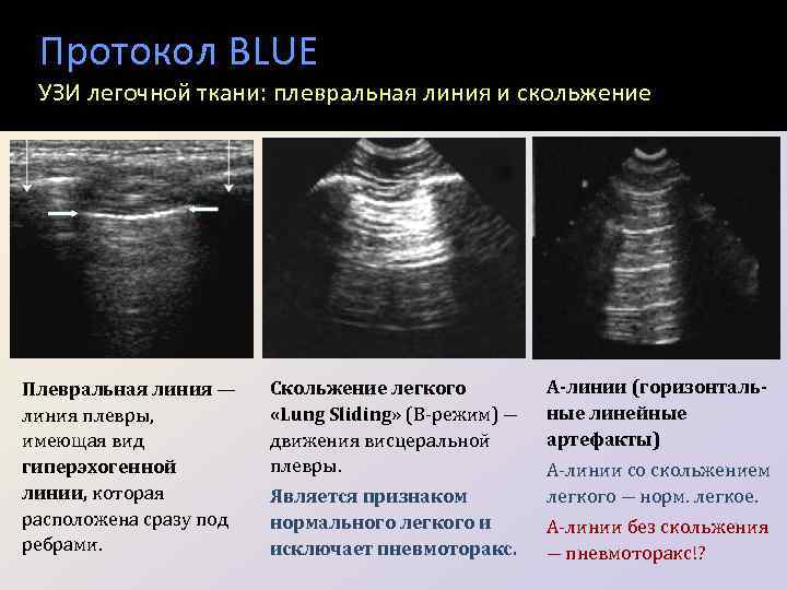 Протокол BLUE УЗИ легочной ткани: плевральная линия и скольжение Плевральная линия — линия плевры,