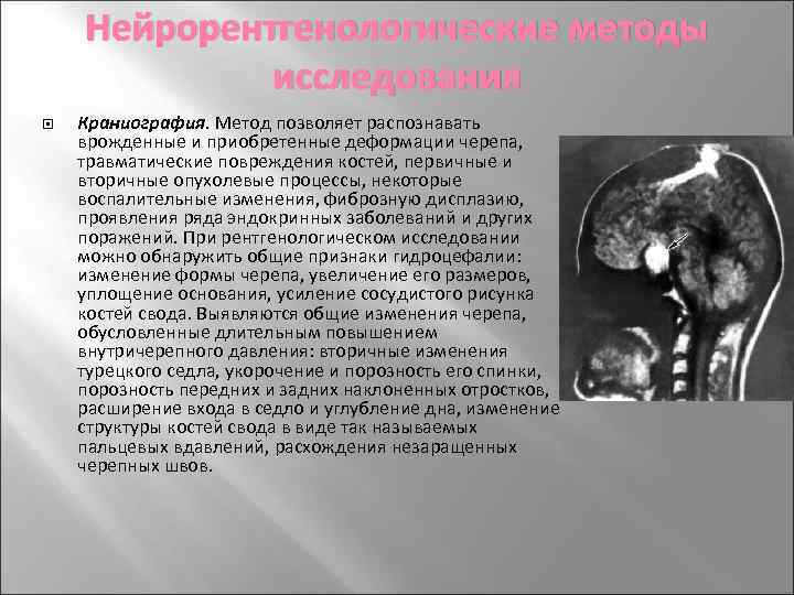 Нейрорентгенологические методы исследования Краниография. Метод позволяет распознавать врожденные и приобретенные деформации черепа, травматические повреждения