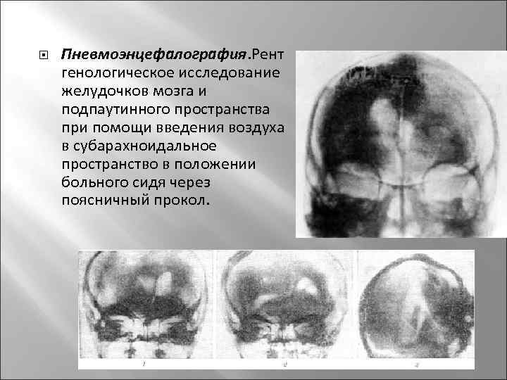  Пневмоэнцефалография. Рент генологическое исследование желудочков мозга и подпаутинного пространства при помощи введения воздуха