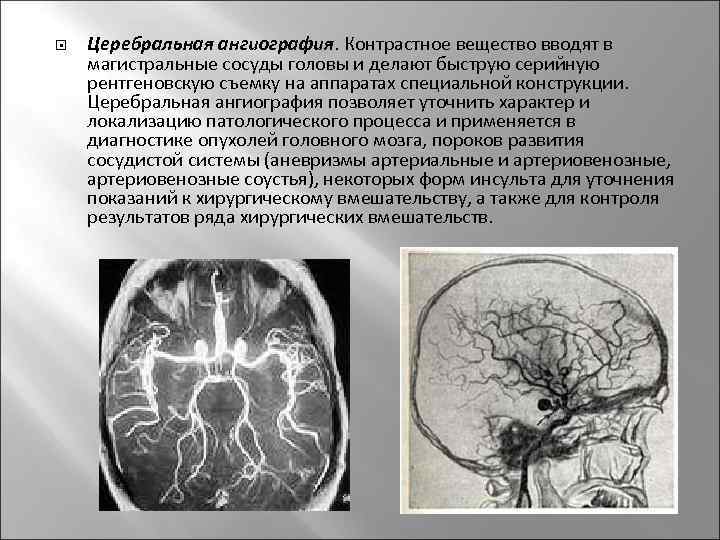  Церебральная ангиография. Контрастное вещество вводят в магистральные сосуды головы и делают быструю серийную
