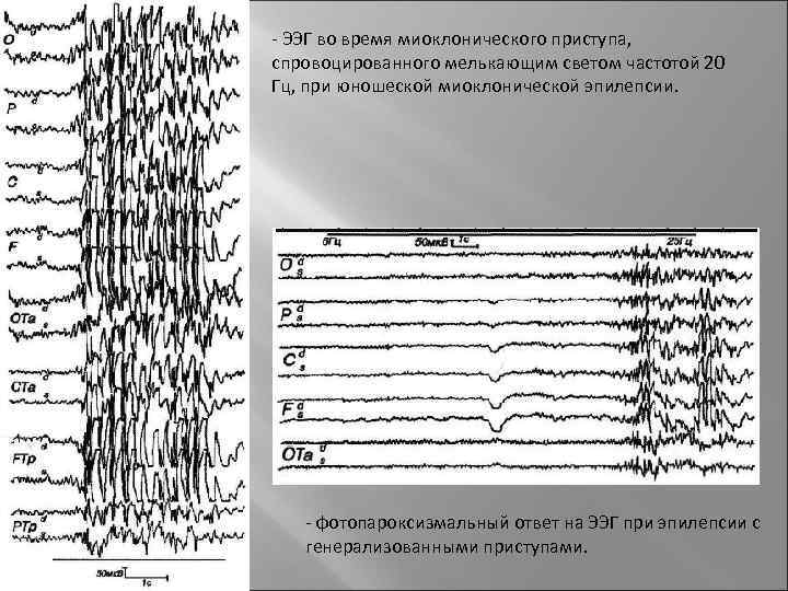Миоклонус эпилепсия ЭЭГ. Отведения ЭЭГ. Волны на ЭЭГ расшифровка.