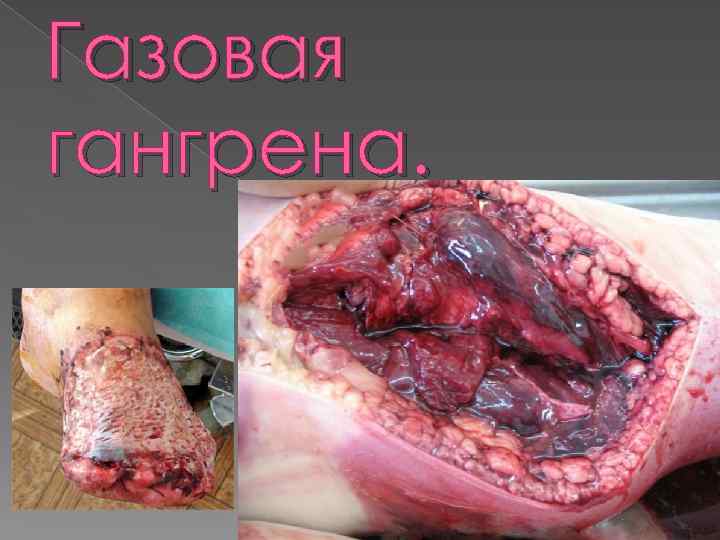 Газовая гангрена. 