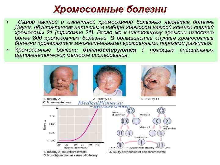 Хромосомные заболевания дауна