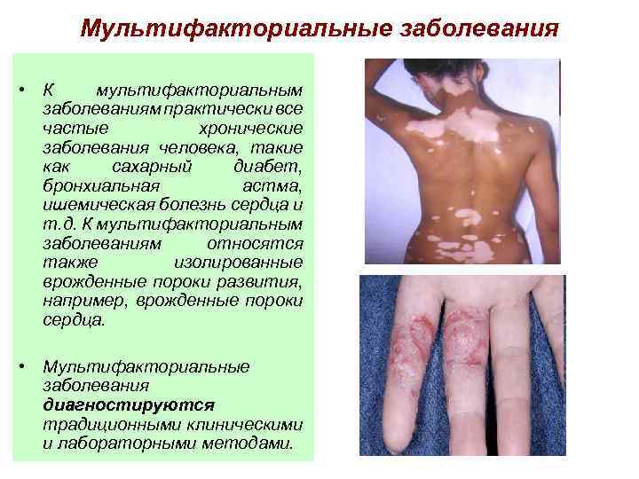 Мультифакториальные заболевания • К мультифакториальным заболеваниям практически все частые хронические заболевания человека, такие как