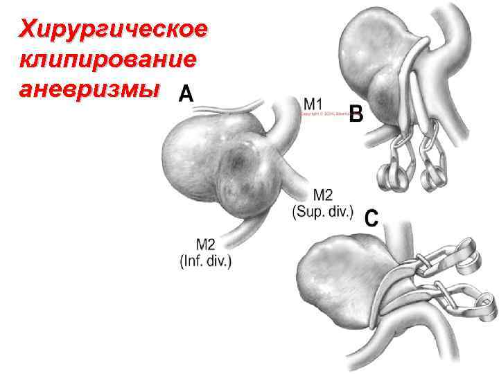 Хирургическое клипирование аневризмы 