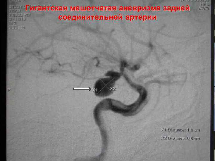 Гигантская мешотчатая аневризма задней соединительной артерии 