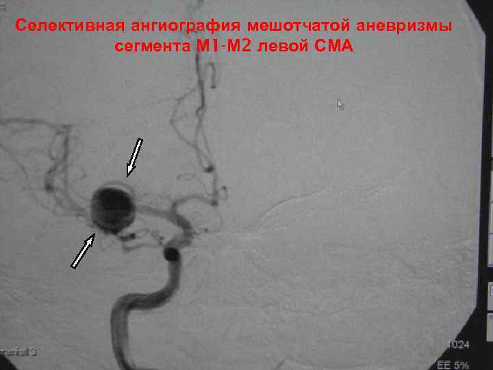 Мешотчатые аневризмы вса. Мешотчатая аневризма ВСА. Аневризма м1 сегмента СМА. Фузиформная аневризма головного мозга. Мешотчатая аневризма левой СМА.