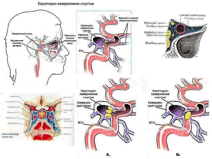 Соустье. Каротидно-кавернозное соустье мрт. Тромбоз каротидно-кавернозного соустья. Тромбоз кавернозного синуса глаза. Артериовенозная аневризма в кавернозном синусе.