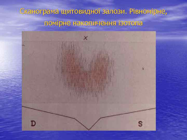 Сканограма щитовидної залози. Рівномірне, помірне накопичення ізотопа 