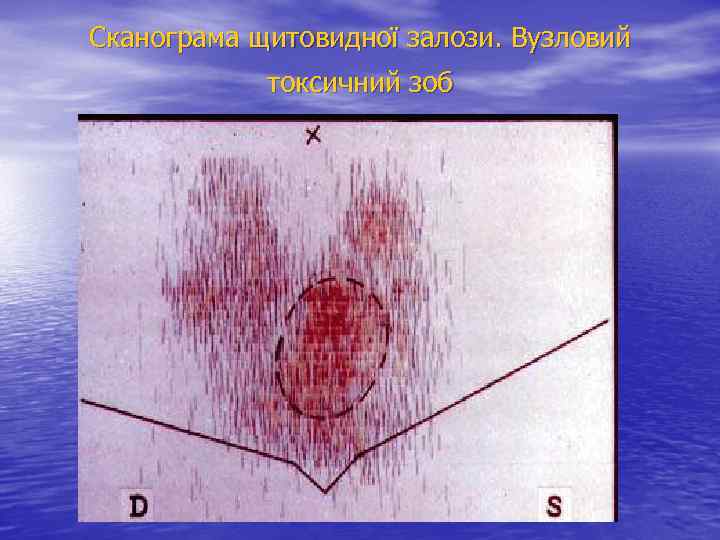 Сканограма щитовидної залози. Вузловий токсичний зоб 