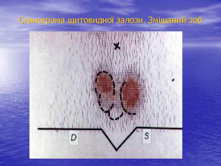 Сканограма щитовидної залози. Змішаний зоб 
