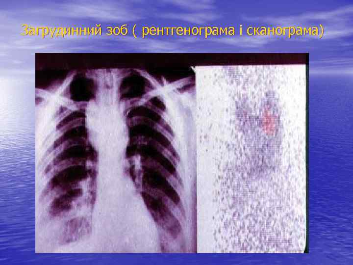 Загрудинний зоб ( рентгенограма і сканограма) 