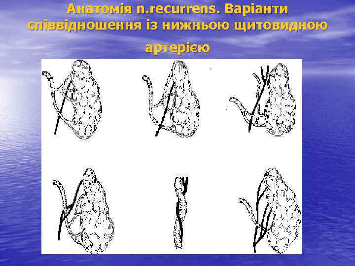 Анатомія n. recurrens. Варіанти співвідношення із нижньою щитовидною артерією 