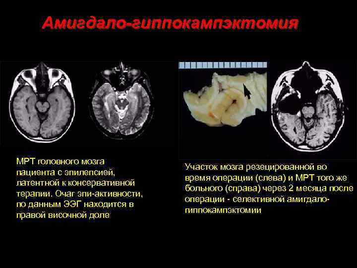 Амигдало-гиппокампэктомия МРТ головного мозга пациента с эпилепсией, латентной к консервативной терапии. Очаг эпи-активности, по