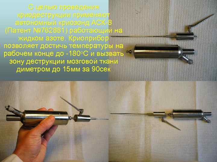 С целью проведения криодеструкции применяют автономный криозонд АСК-8 (Патент № 762881) работающий на жидком