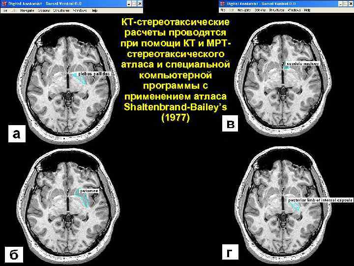 КТ-стереотаксические расчеты проводятся при помощи КТ и МРТстереотаксического атласа и специальной компьютерной программы с