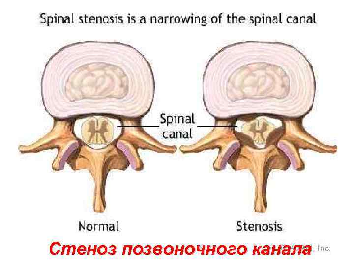 Стеноз позвоночного канала 
