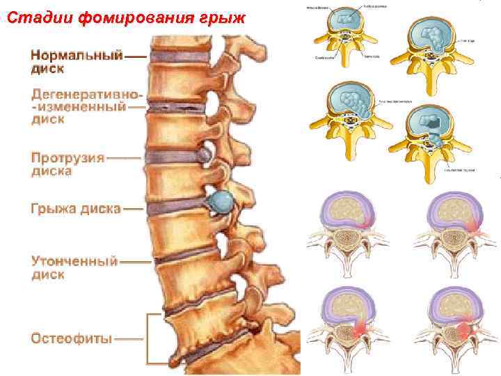 Стадии фомирования грыж 