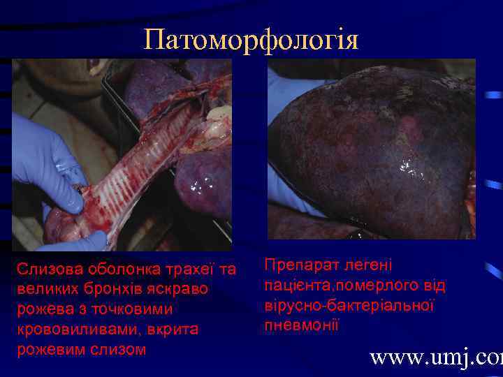 Патоморфологія Слизова оболонка трахеї та великих бронхів яскраво рожева з точковими крововиливами, вкрита рожевим