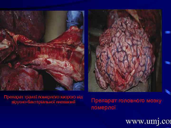 Препарат трахеї померлого хворого від вірусно-бактеріальної пневмонії Препарат головного мозку померлої www. umj. com