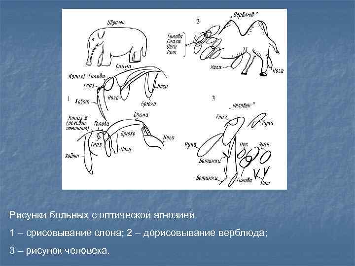 Рисунки больных с оптической агнозией 1 – срисовывание слона; 2 – дорисовывание верблюда; 3
