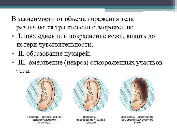 В зависимости от объема поражения тела различаются три степени отморожения: • I. побледнение и