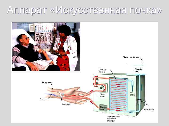 Аппарат «Искусственная почка» 