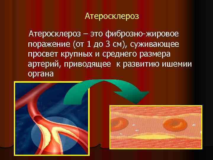 Атеросклероз – это фиброзно-жировое поражение (от 1 до 3 см), суживающее просвет крупных и
