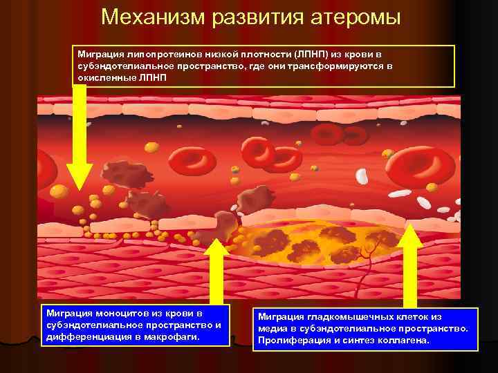 Механизм развития атеромы Миграция липопротеинов низкой плотности (ЛПНП) из крови в субэндотелиальное пространство, где
