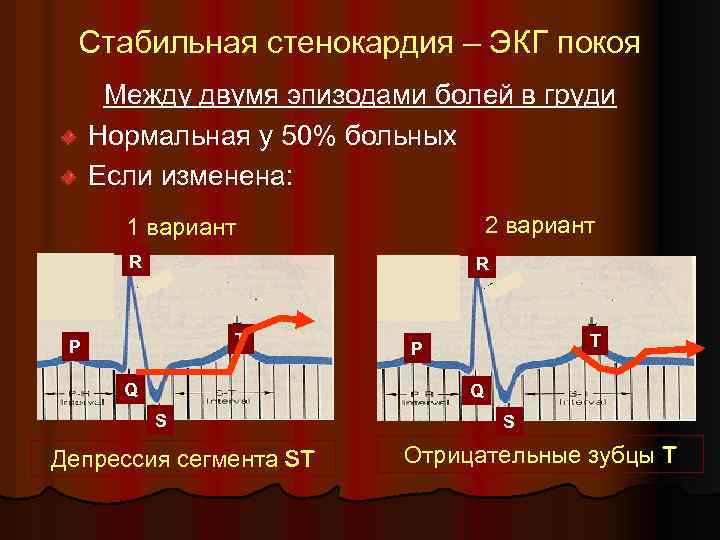 Стабильная стенокардия – ЭКГ покоя Между двумя эпизодами болей в груди Нормальная у 50%