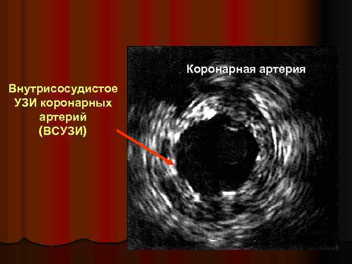 Коронарная артерия Внутрисосудистое УЗИ коронарных артерий (ВСУЗИ) 