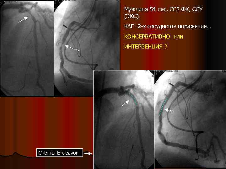 Мужчина 54 лет, СС 2 ФК, ССУ (ЭКС) КАГ=2 -х сосудистое поражение… КОНСЕРВАТИВНО или