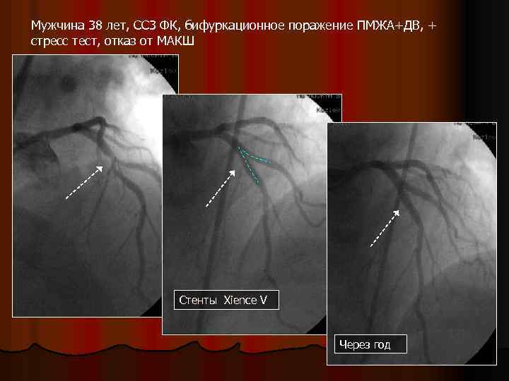 Мужчина 38 лет, СС 3 ФК, бифуркационное поражение ПМЖА+ДВ, + стресс тест, отказ от