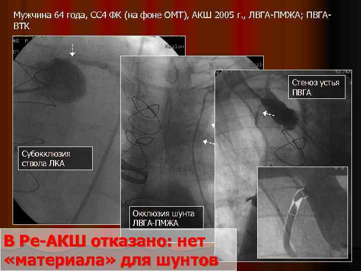Мужчина 64 года, СС 4 ФК (на фоне ОМТ), АКШ 2005 г. , ЛВГА-ПМЖА