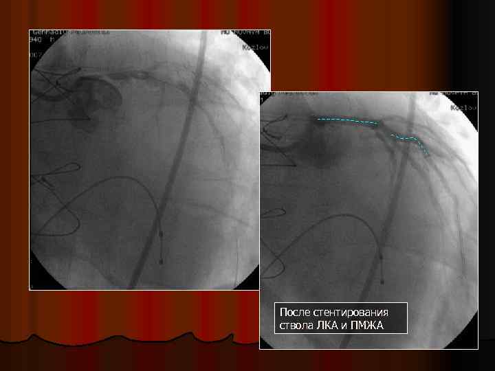 После стентирования ствола ЛКА и ПМЖА 
