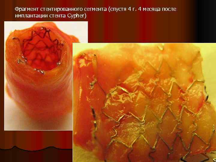 Фрагмент стентированного сегмента (спустя 4 г. 4 месяца после имплантации стента Cypher) 