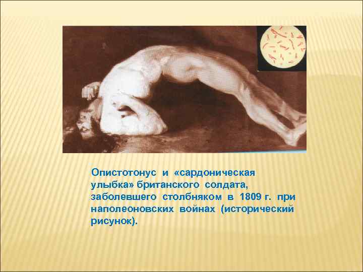 Опистотонус и «сардоническая улыбка» британского солдата, заболевшего столбняком в 1809 г. при наполеоновских войнах