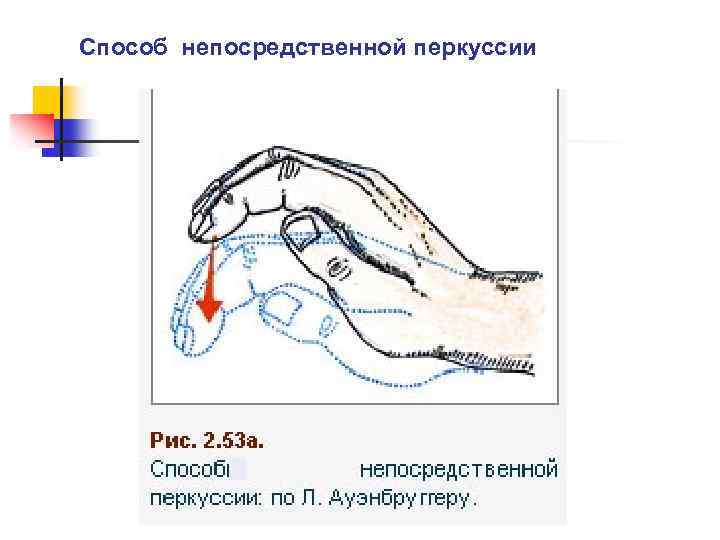 Способ непосредственной перкуссии 