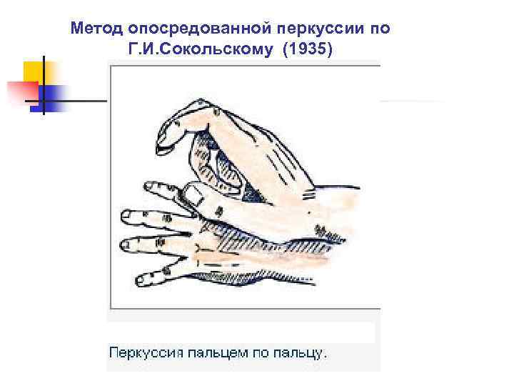 Метод опосредованной перкуссии по Г. И. Сокольскому (1935) 