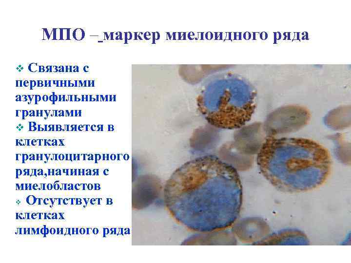 МПО – маркер миелоидного ряда Связана с первичными азурофильными гранулами v Выявляется в клетках