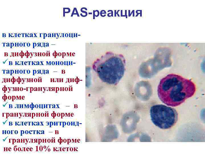 Моноцитарный лейкоз картина крови