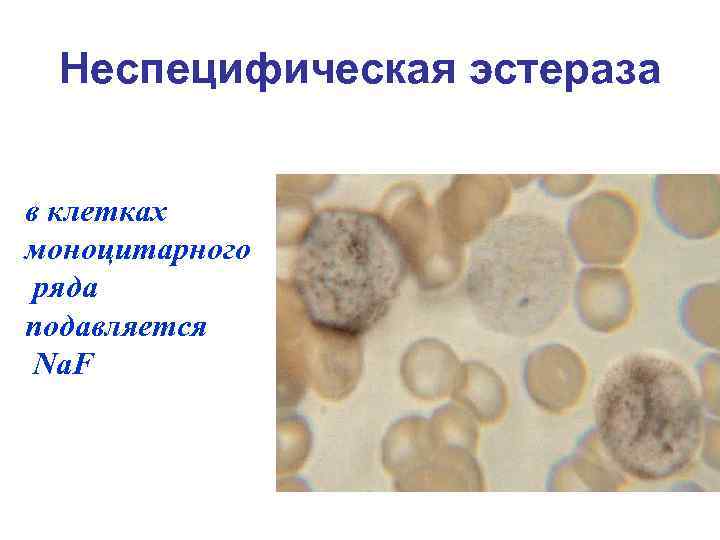 Неспецифическая эстераза в клетках моноцитарного ряда подавляется Na. F 