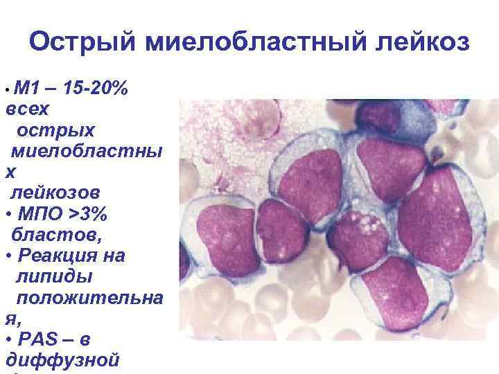 Острый миелобластный лейкоз • М 1 – 15 -20% всех острых миелобластны х лейкозов