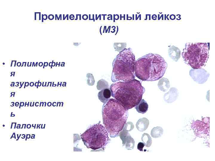 Промиелоцитарный лейкоз (М 3) • Полиморфна я азурофильна я зернистост ь • Палочки Ауэра