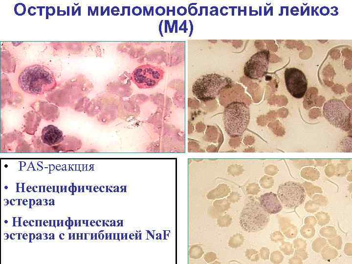 Острый миеломонобластный лейкоз (М 4) • PAS-реакция • Неспецифическая эстераза с ингибицией Na. F