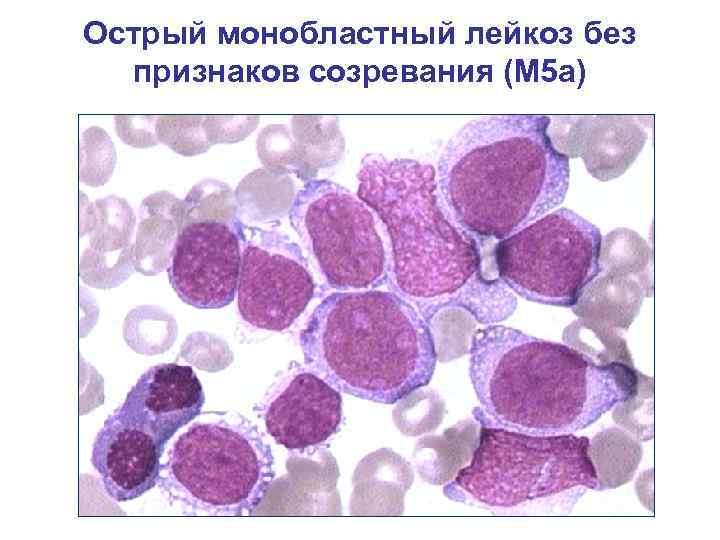 Острый монобластный лейкоз без признаков созревания (М 5 а) 