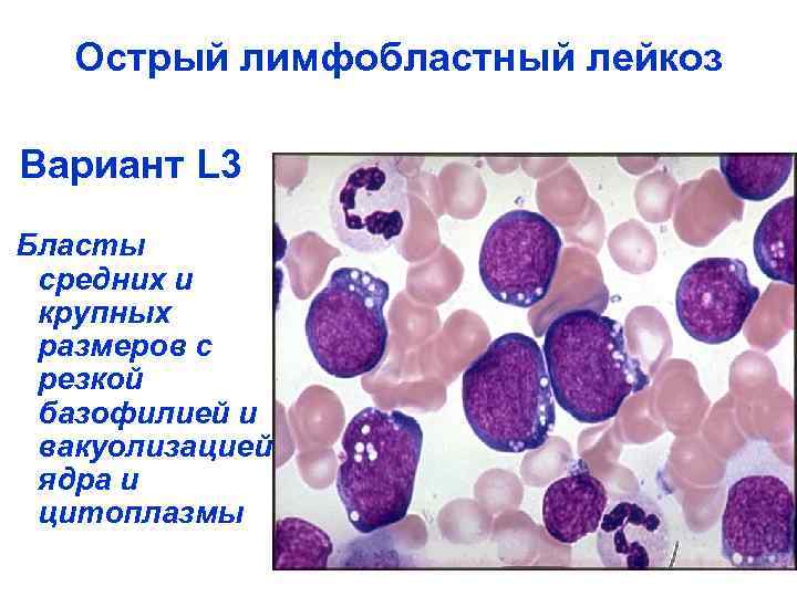 Острый лимфобластный лейкоз Вариант L 3 Бласты средних и крупных размеров с резкой базофилией