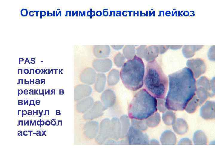Острый лимфобластный лейкоз РАS - положитк льная реакция в виде гранул в лимфобл аст-ах