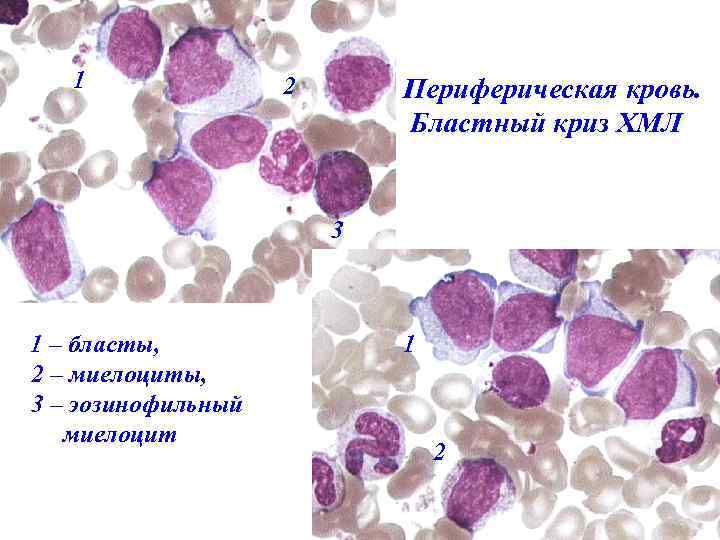 1 2 Периферическая кровь. Бластный криз ХМЛ 3 1 – бласты, 2 – миелоциты,